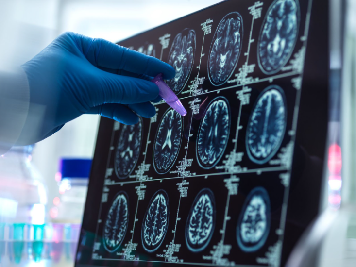 Novo exame pode detectar Alzheimer anos antes dos primeiros sintomas